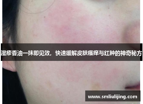 湿疹香油一抹即见效，快速缓解皮肤瘙痒与红肿的神奇秘方